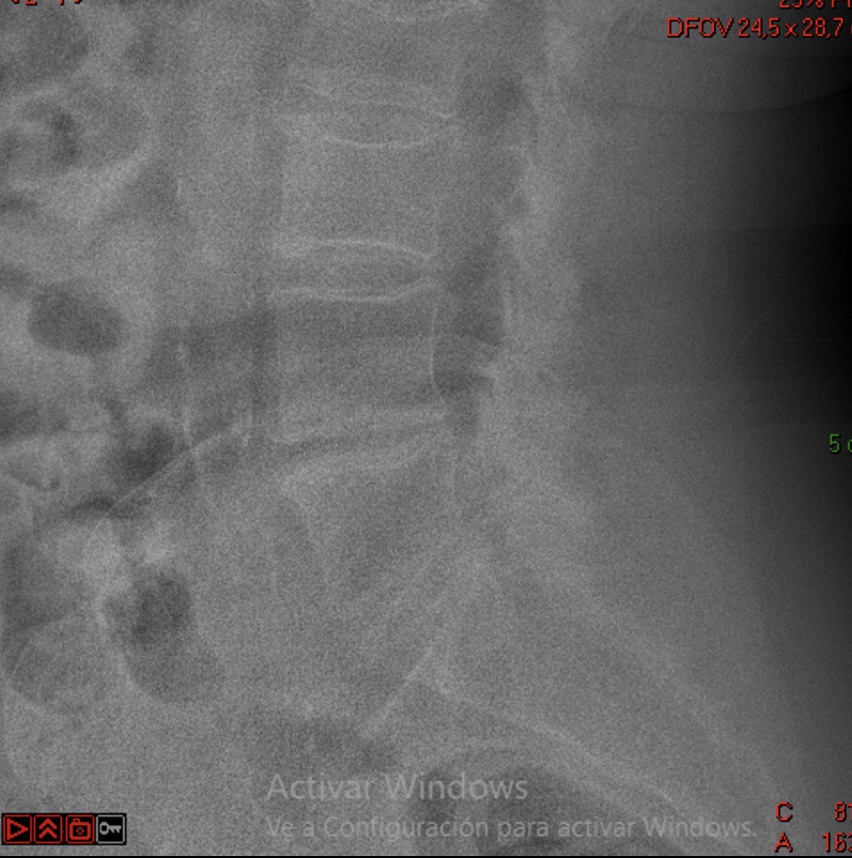 Radiografía lateral con los parámetros espinopélvicos medidos en SpineCalc